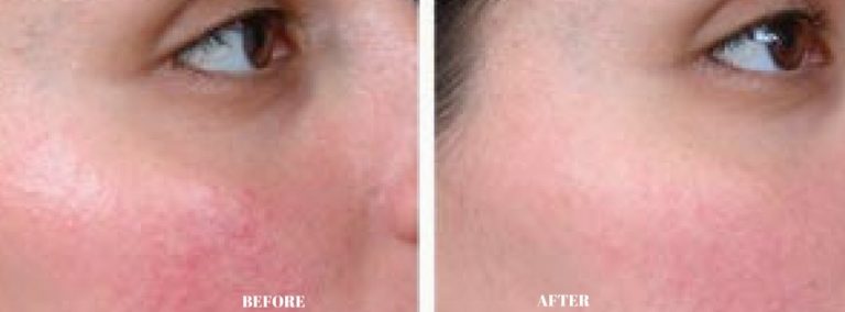 Revitol-Rosacea-Cream-before and after 2