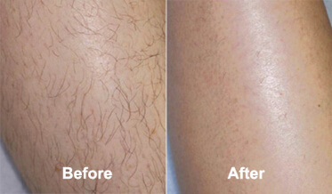 Revitol-Hair-Removal-Cream-results