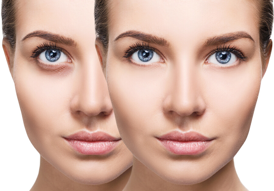 Under-Eye Fillers - What to Expect After the Procedure