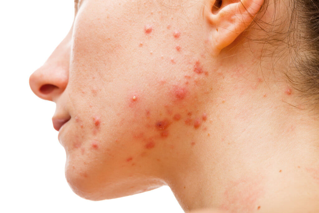 Causes of Adult Acne