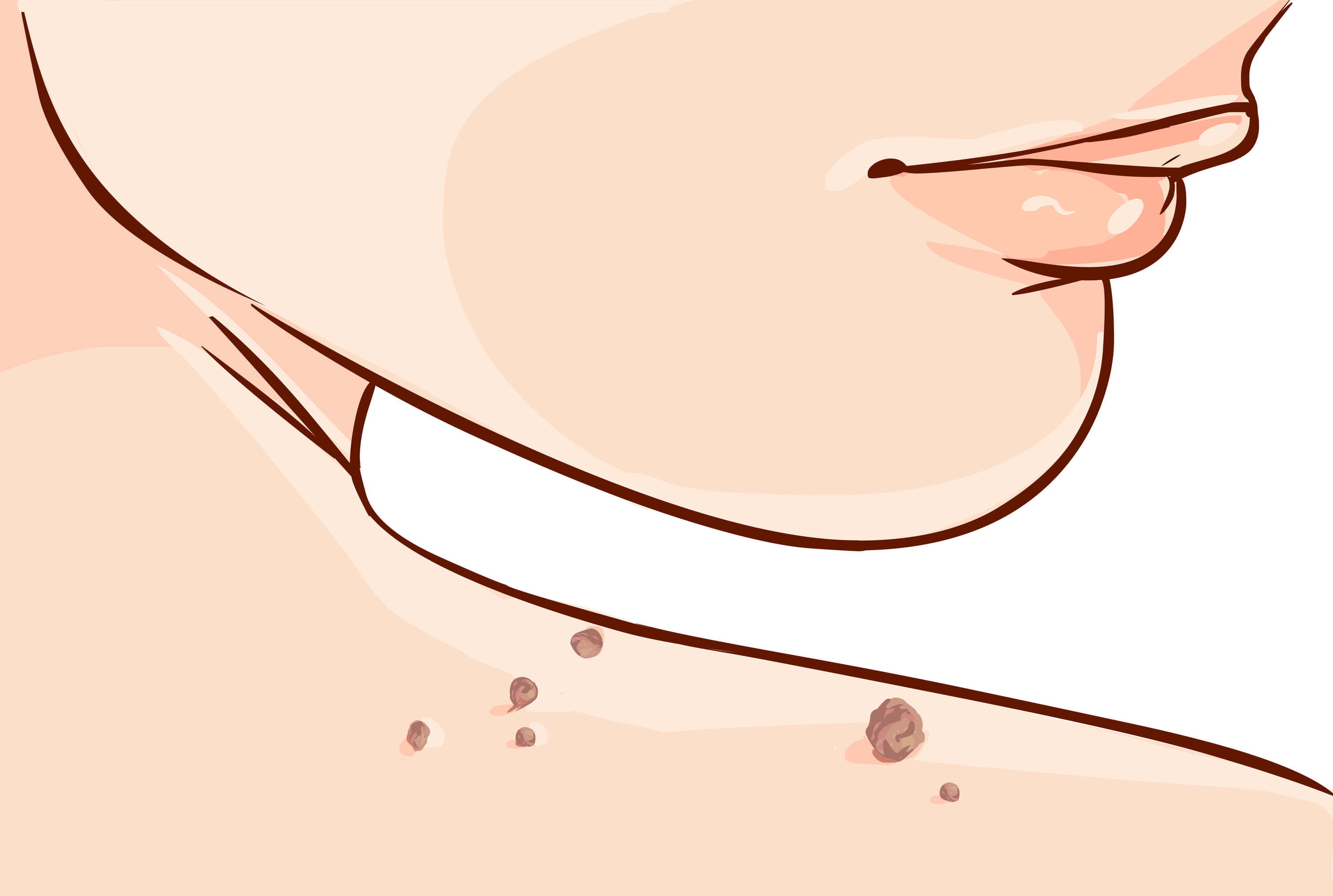 How to Remove A Skin Tag At Home